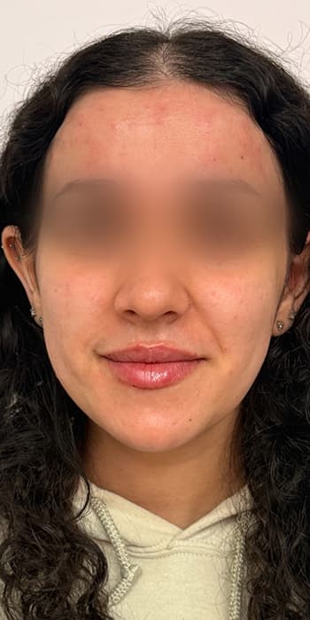 After treatment